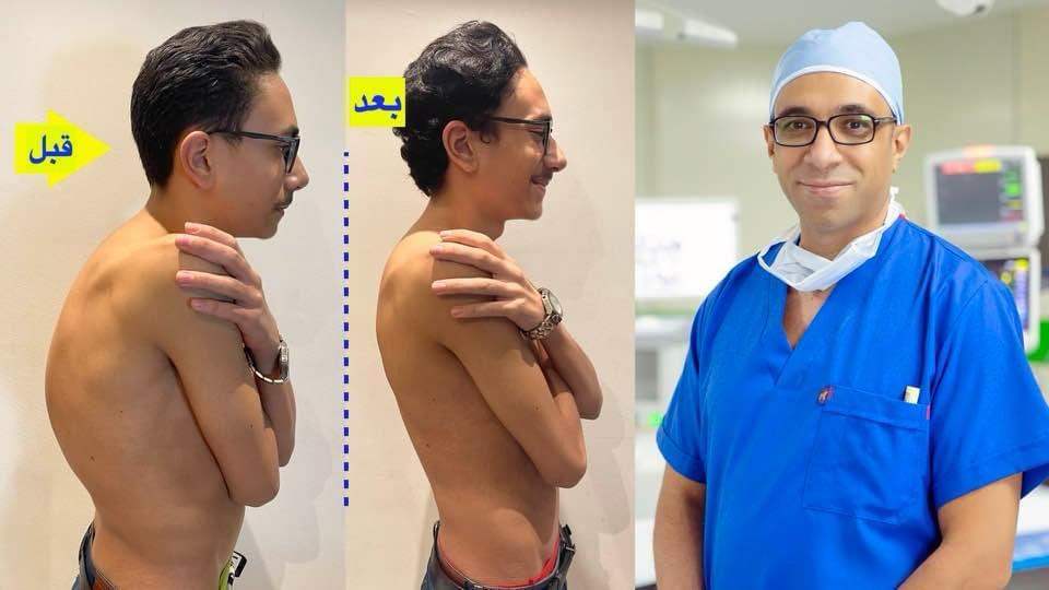 Kyphosis Correction Surgeries