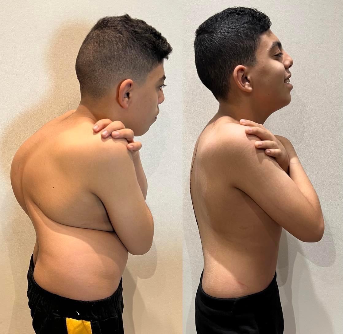 Kyphoscoliosis Correction surgeries