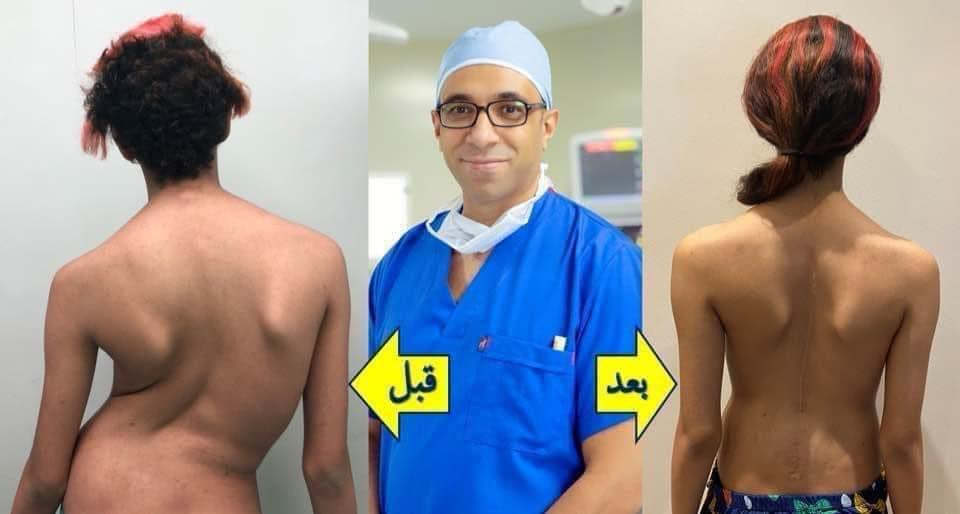 جراحات تصحيح اعوجاج العمود الفقري (الجنف)