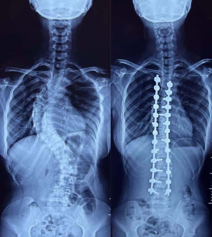 Scoliosis Correction Surgeries