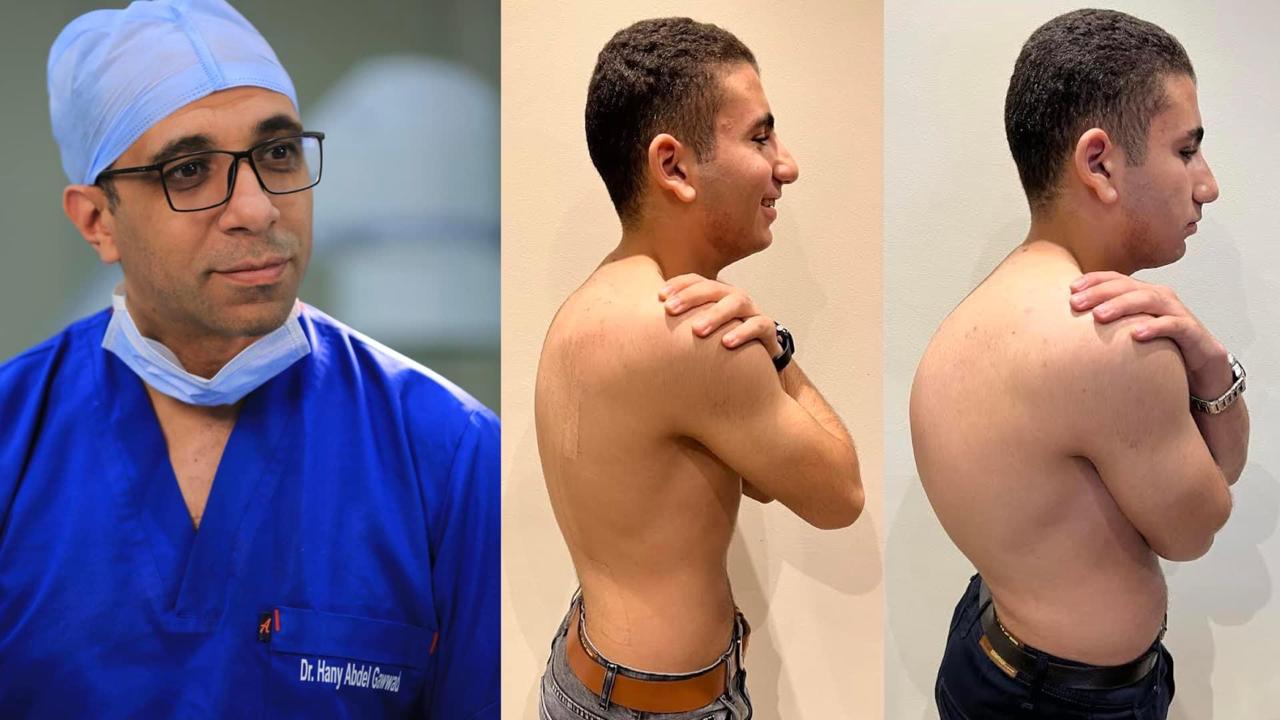 Kyphosis Correction Surgeries