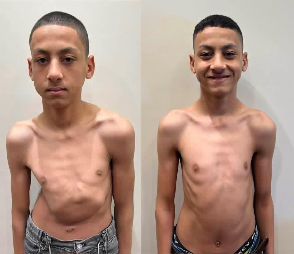 Kyphoscoliosis Correction surgeries