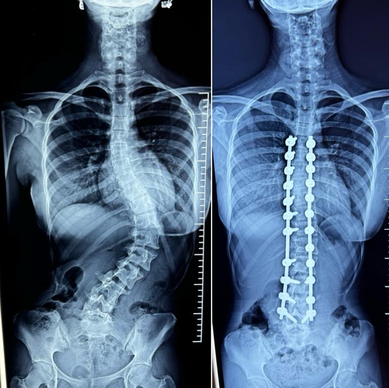 Scoliosis Correction Surgeries