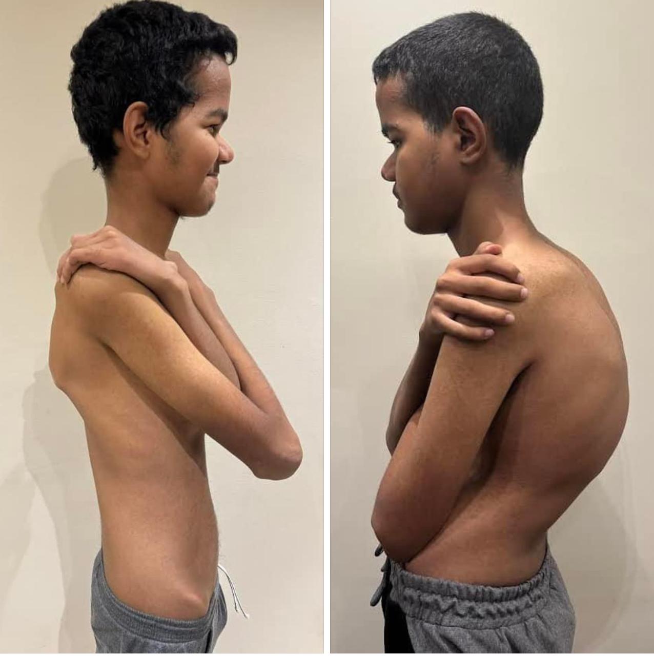 Kyphosis Correction Surgeries