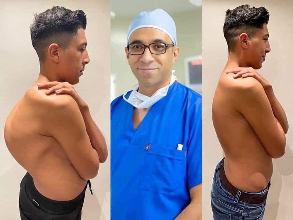 Kyphosis Correction Surgeries
