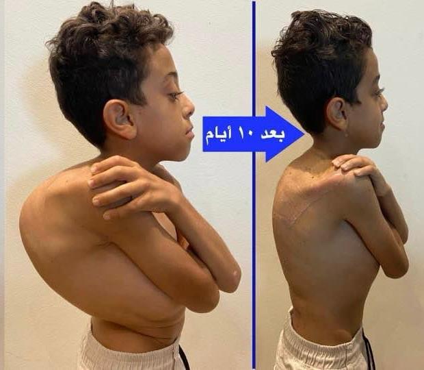 Kyphosis Correction Surgeries