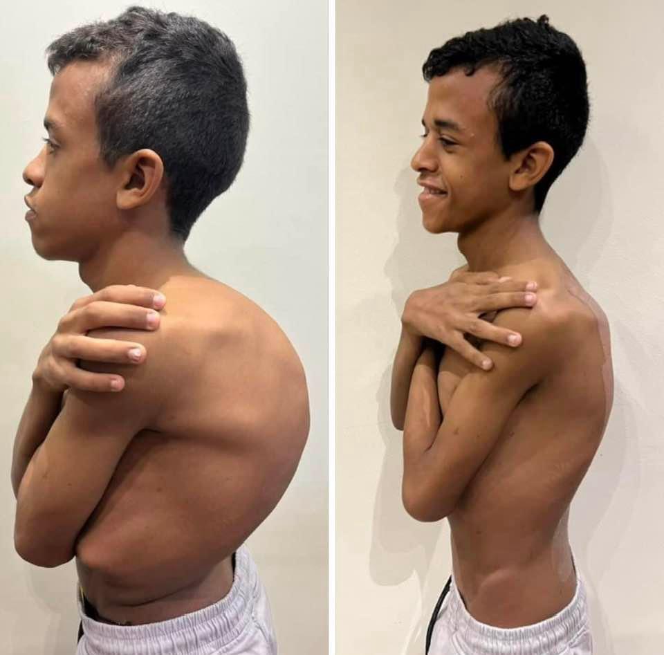 Kyphoscoliosis Correction surgeries
