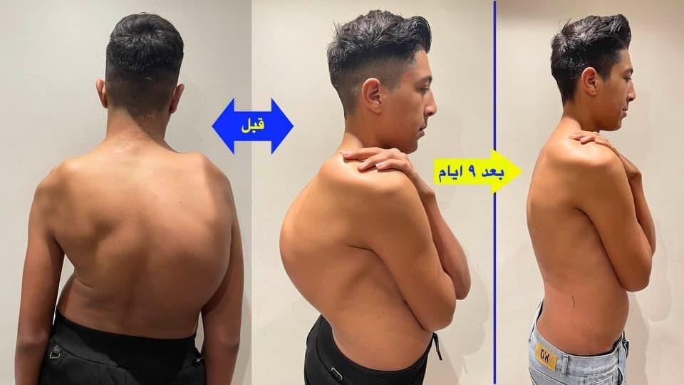 Kyphoscoliosis Correction surgeries