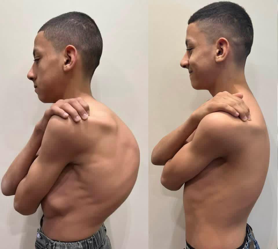 Kyphoscoliosis Correction surgeries