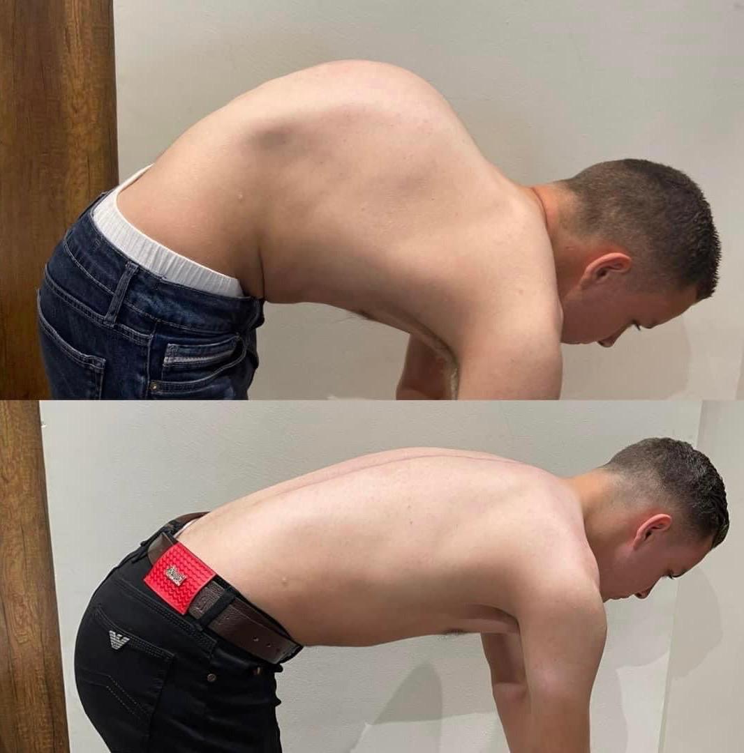 Kyphosis Correction Surgeries