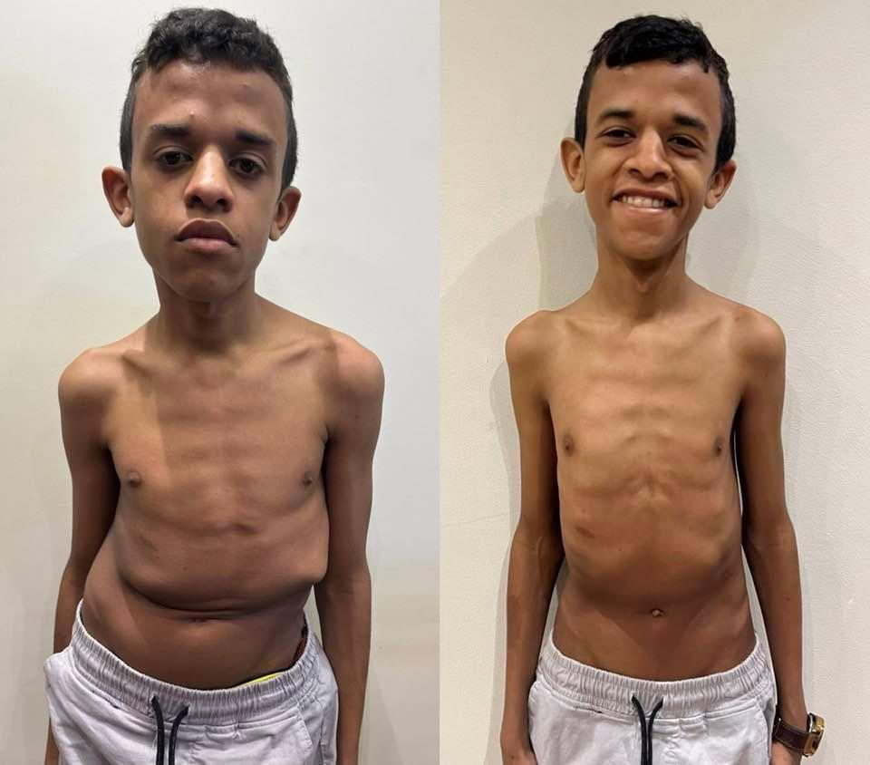 Kyphoscoliosis Correction surgeries
