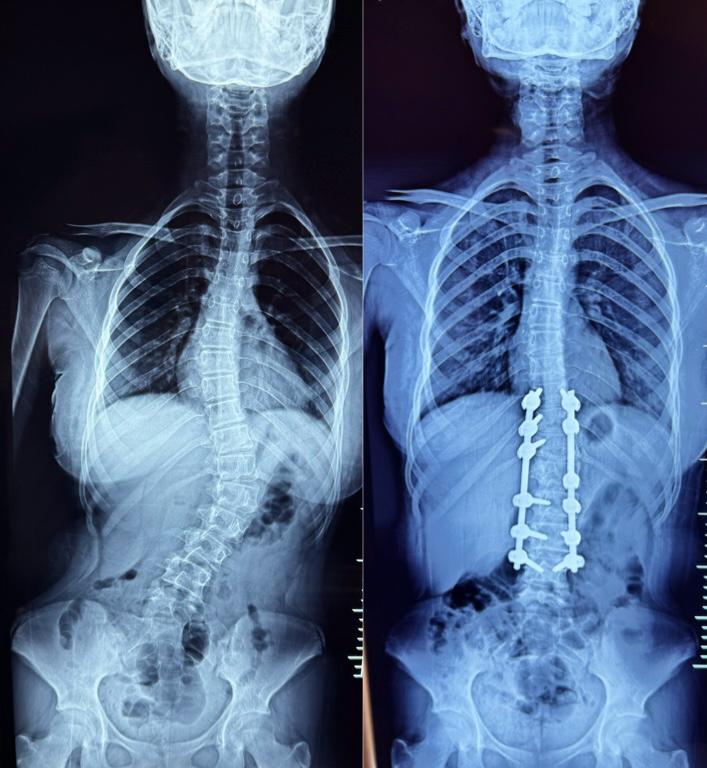 Scoliosis Correction Surgeries