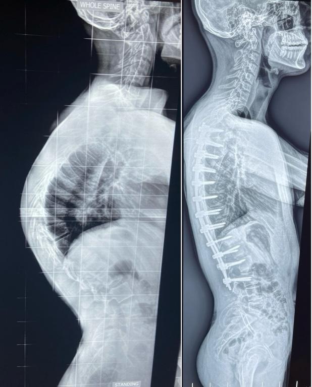 Kyphosis Correction Surgeries