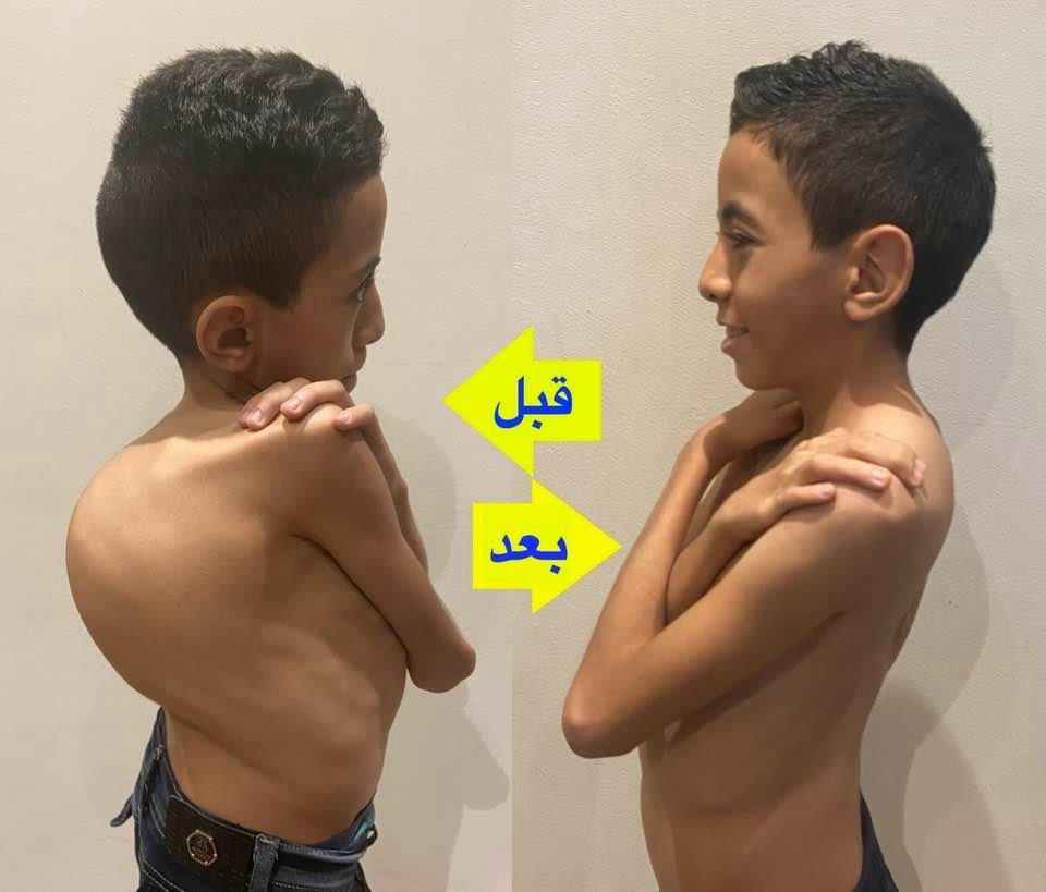 Kyphoscoliosis Correction surgeries