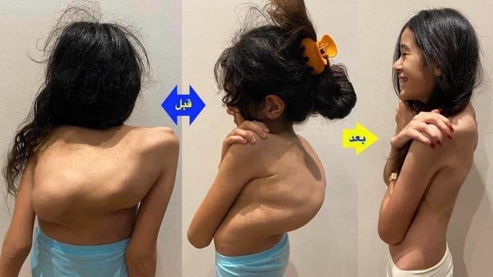 Kyphoscoliosis Correction surgeries