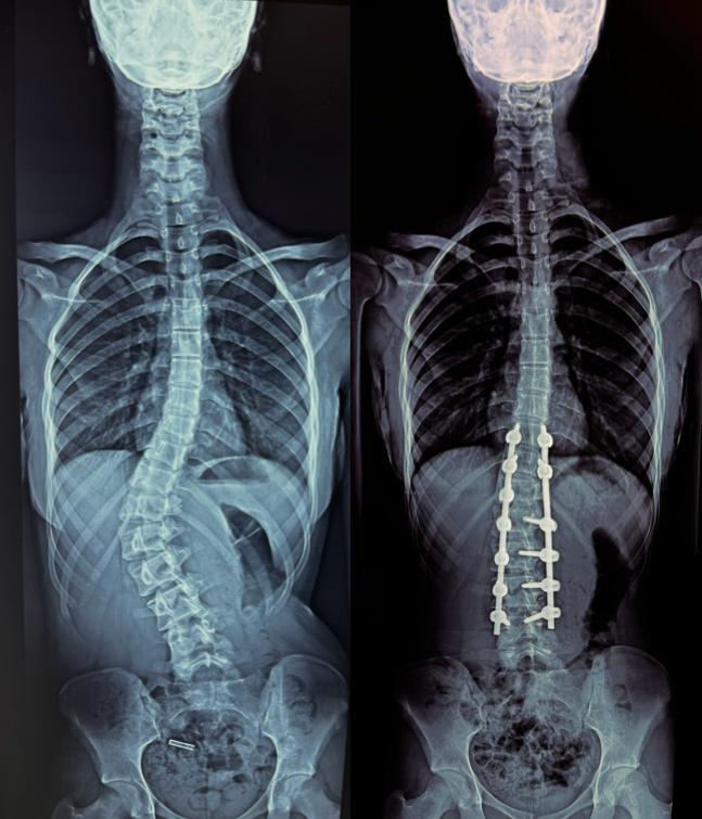 Scoliosis Correction Surgeries
