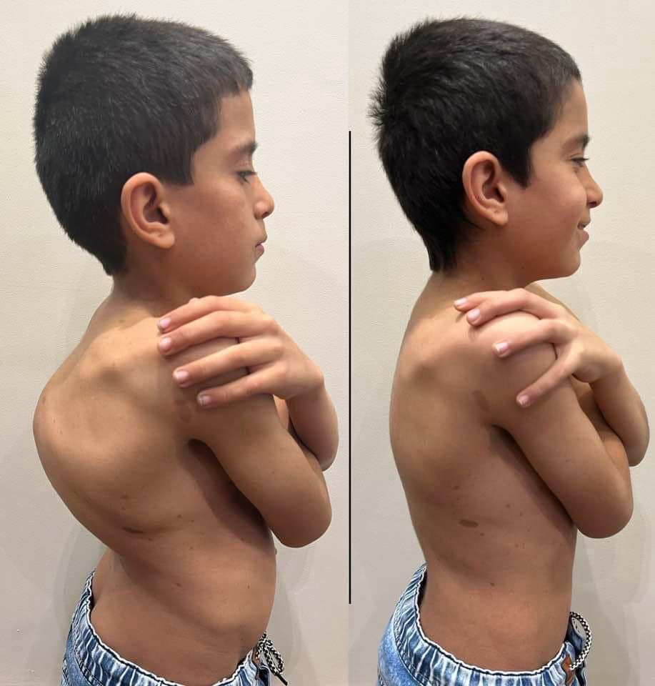 Kyphoscoliosis Correction surgeries