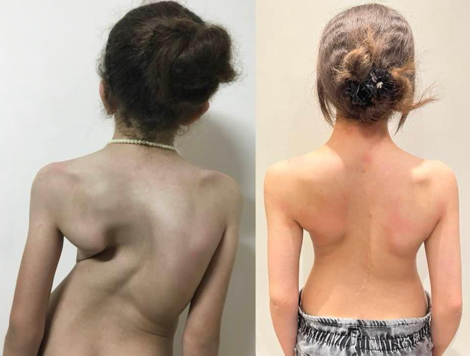 Scoliosis Correction Surgeries