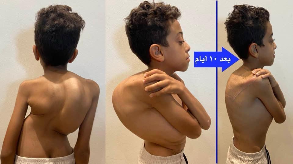 Kyphoscoliosis Correction surgeries