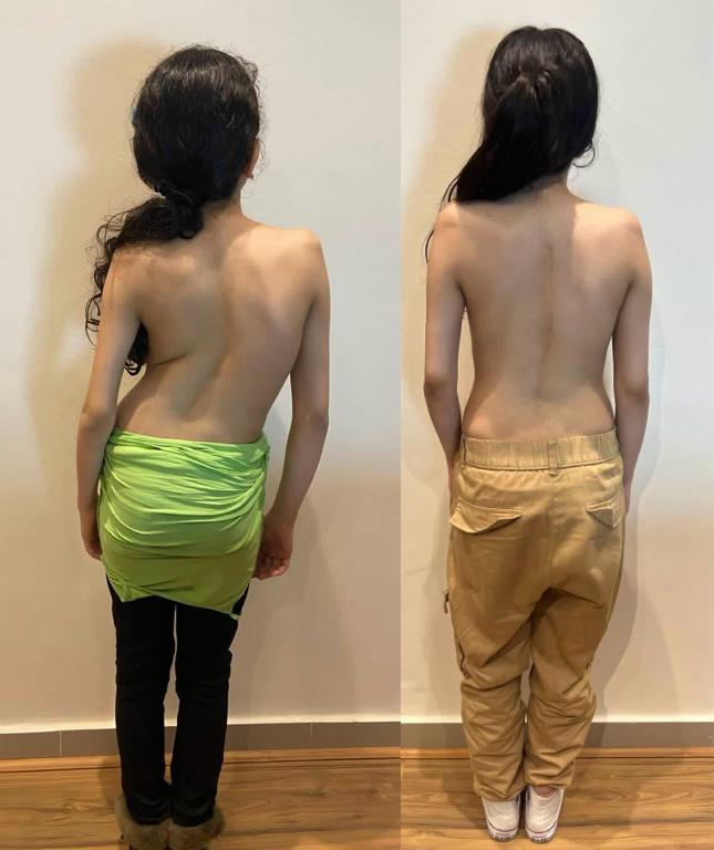 Scoliosis Correction Surgeries