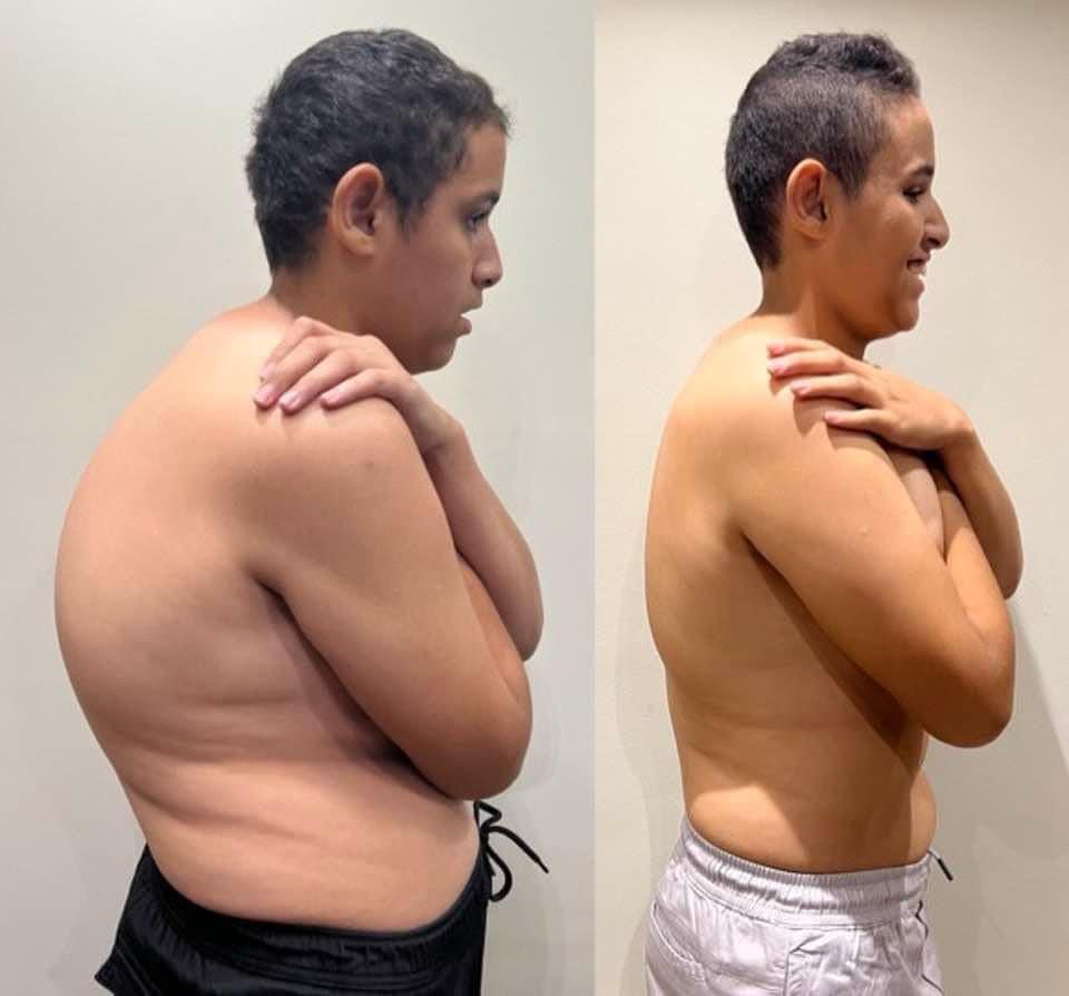 Kyphosis Correction Surgeries
