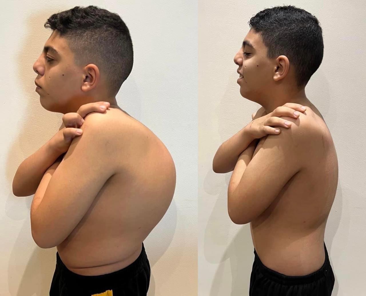 Kyphoscoliosis Correction surgeries