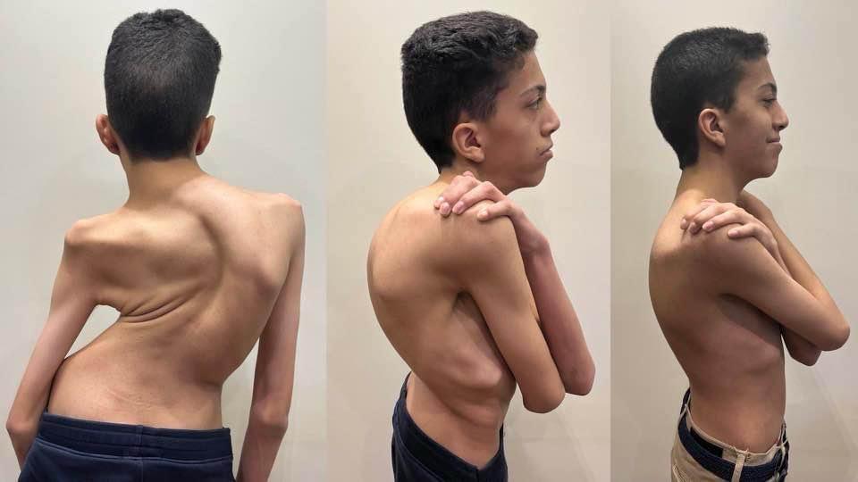 Kyphoscoliosis Correction surgeries