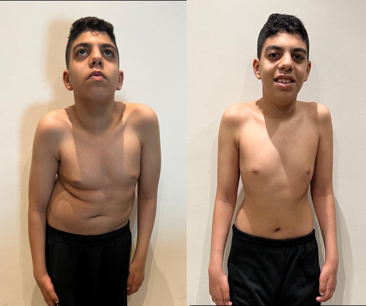 Kyphoscoliosis Correction surgeries